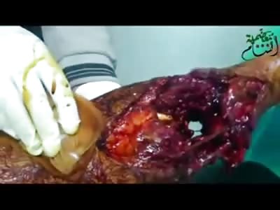 Disgusting Leg Wound Needs to be Amputated