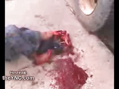 Foot ripped off by a Truck