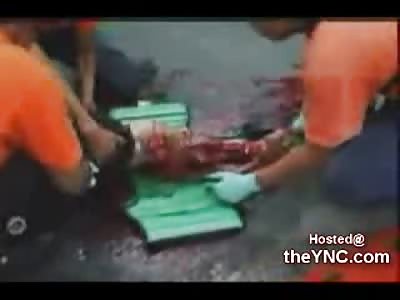 Woman hit by Car has no Skin left on her Legs