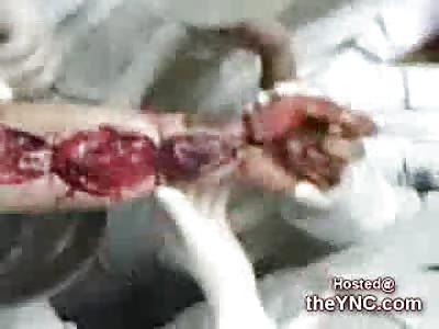 Burn by electricity opens a Female's Arm Wide Open