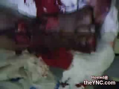 Horrific Crushed Foot resulting in an Amputation