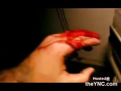 Kid continues to Tape after slicing off his Finger