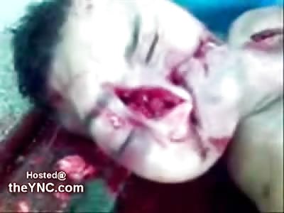 Up Close Footage of a Man with No Face from a Shotgun Blast Suicide