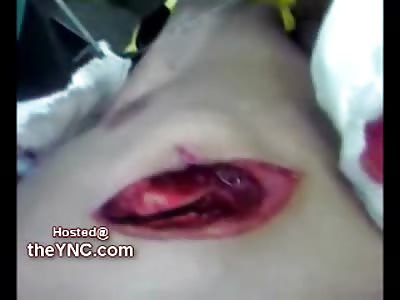 Wide Open Stab Wound