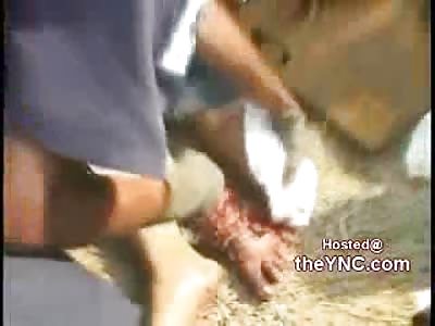 Foot Severed in Horrific Motorcycle Accident