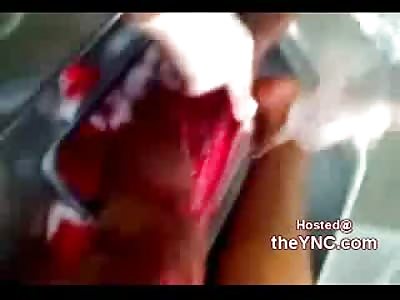 Laughing Doctors Repair Mans Fucked up Leg