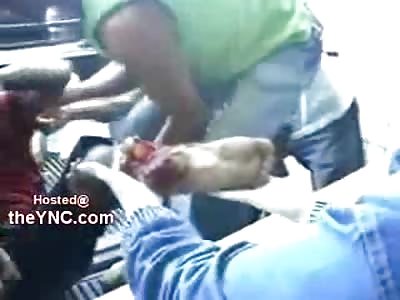 Man Loaded from Pickup Truck..Foot Severed from the Bone