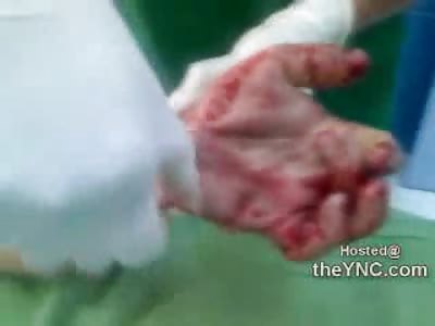 Holy Shit: The Most Horrific Hand Injury