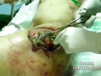 Man with Gruesome Infected Ulcerous Infection