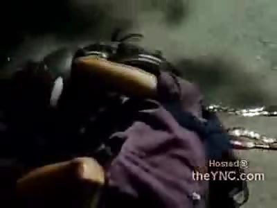 Pretzled and Brain Leakage Following Accident