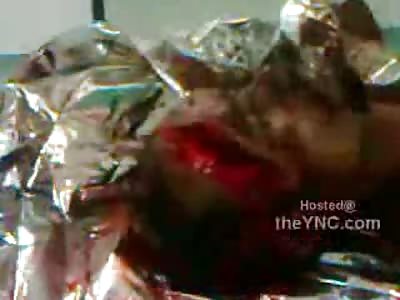 Hospital Crew in Awe by Mans Head Sliced up by Machete Attack