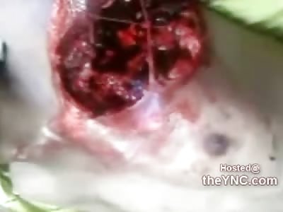 Man Wearing his Heart on his Sleeve, Still Awake Heart Exposed from Accident