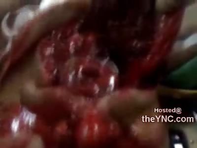 Dying Man with Line inside Mouth and Throat is Recorded by a Nurse