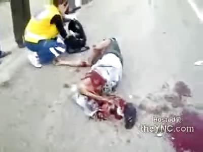 Accident in Turkey Leaves one Man Faceless and Another Guy Legless 