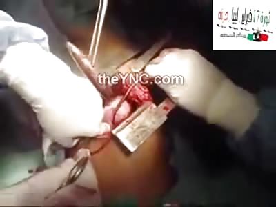 Large Caliber  Bullet taken out of 12 Year Old Girl