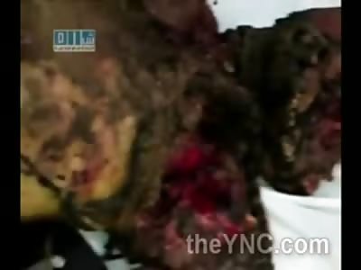 Ripped in Pieces from Bomb Attack in Syria