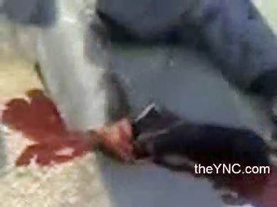 The Calmest Man you'll Ever Meet with a Severed Foot and Tendons Hanging out of Socket