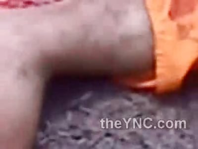 Man with Muscles Exposed after Brutal Road Crash