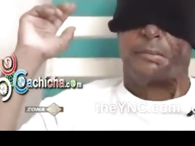 Insane Girlfriend Throws Acid in her Mans Face after She Accused him of Molesting Her Daughter