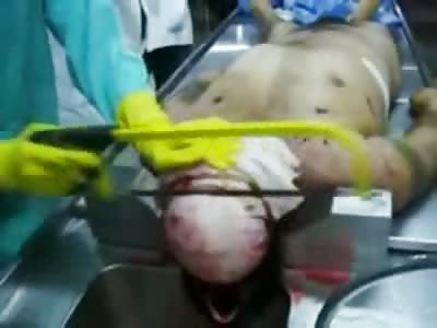 Short Video of Hacksaw Skull Opening and Washing of the Brain