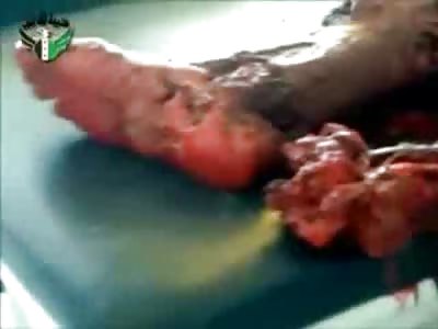 Land Mine blew Off Man's Leg and he's Wide Awake