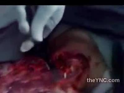 FACE OFF: Mans Face Ripped off During Horrible Drug Cartel Torture
