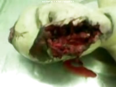 Suicide Entrance and Exit Wound Boy stares at you in the Morgue