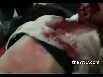 Little Girl Looks like a Zombie After Bomb Attack