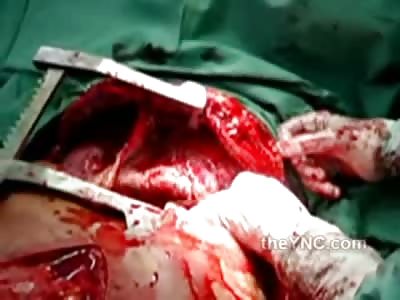 Surgeons Perform Emergency Open Heart Surgery on Dying Man