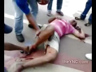 Foot left Dangling after Terrible Accident 