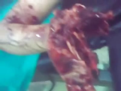 Shocking Video of Poor whining Boy with BOTH Hands Blown off by a Landmine