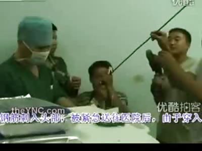 Man has Iron Rod Stuck Through His Eye