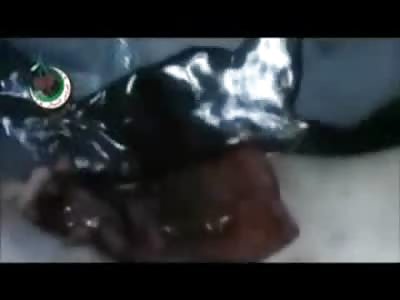 Horrible Video of 7 Year Old Girl in Full Shock with her Legs Blown Apart