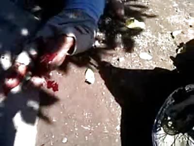 Horrible Leg Hanging by String and Bone Exposed...Man in Total Agony