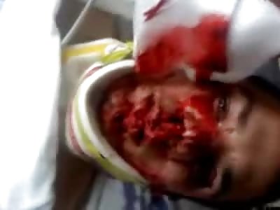 Man Turned Pig Face from Motorcycle Accident