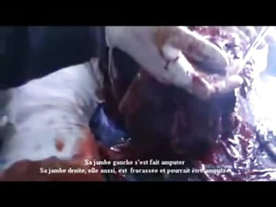 Disgusting Amputation of Young Kids Left Leg... 