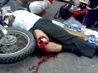 Horrible Fracture Exposed after Motorcycle Accident