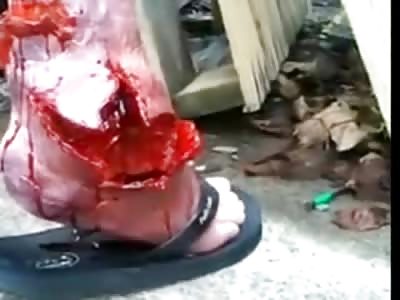 Ankle Ripped apart Crazy Guy showing it off like a Boss