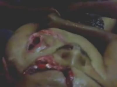 Missing an Eye Man Attacked by a Wood Chipper is Trying to Hang onto Life..