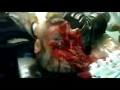 Mans Face Half Gone From what Appears to be a Gunshot