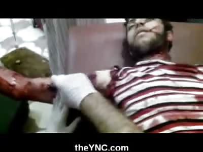 HUGE Gaping Hole in mans Bicep .... in total Shock