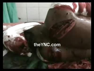 Hyper-Ventilating Man with Gaping Slices to the Bone wants Help on Hospital Bed 