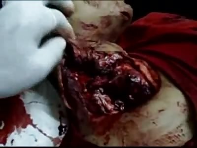 Boy with Wide Open Throat on the Morgue Table