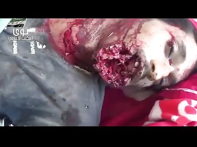 Mouth Gone.....FSA Rebel Chin Shot Off