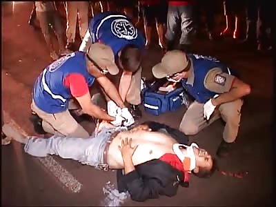 Gruesome Gruesome Compound Femur Fracture 