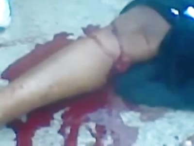 Machete Wounds....Oh, You Know Nothing a Little Rubbing Alcohol and TLC wont' Cure