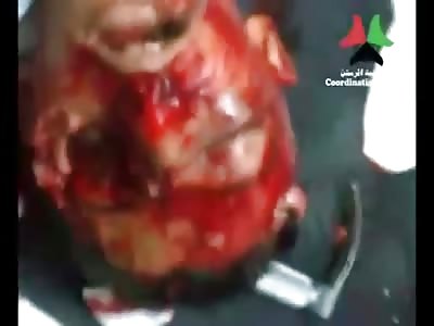 Kid Shot in the Eye in Agonizing Pain and He's Worked on