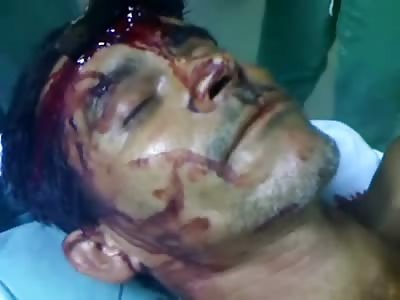 Man with Blade stuck in his Forehead Wide awake and Talking