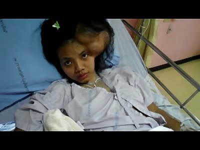 Pretty Young Girl with Huge Tumor on her Head