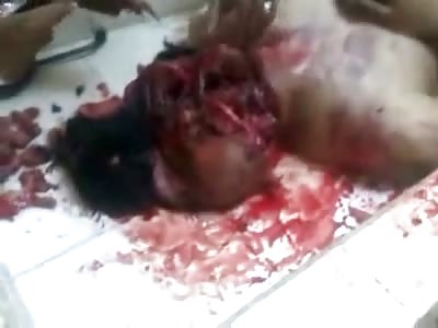 Stitching Together a Dead Mans Mess on the Morgue Table